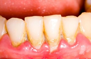 Зубной налет: образование, развитие, последствия и способы профилактики